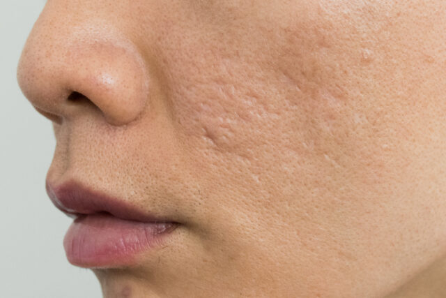 Best Acne Scars Treatments That Actually Work