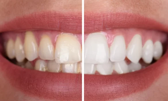 Dental Whitening Gel – How It Should Be Used Effectively?