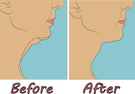 How can chin sculpting treatment help you?