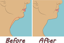 How can chin sculpting treatment help you?